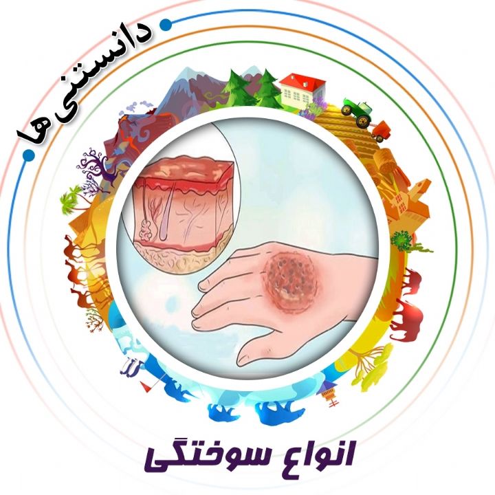 جلد انواع سوختگی